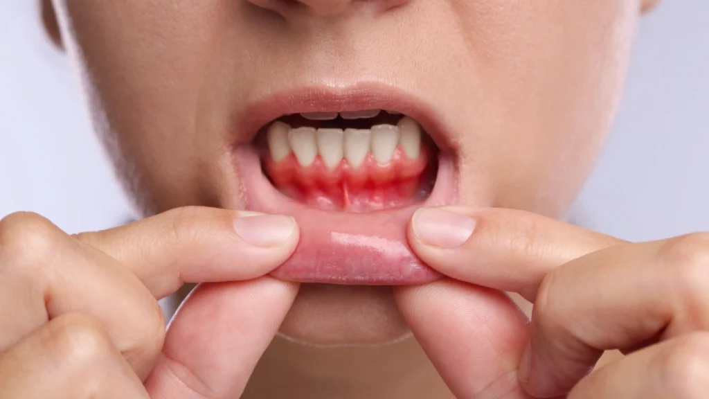 Bacteria Travel Directly From Gums to Your Heart