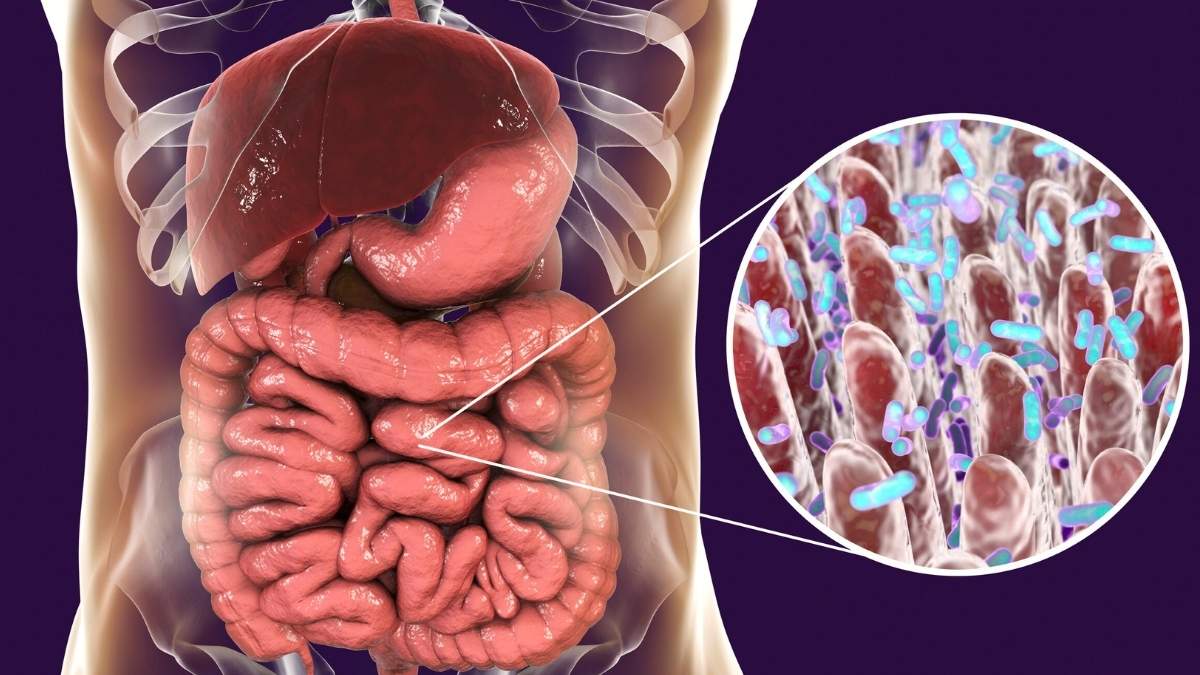 Small Intestinal Bacterial Overgrowth (SIBO