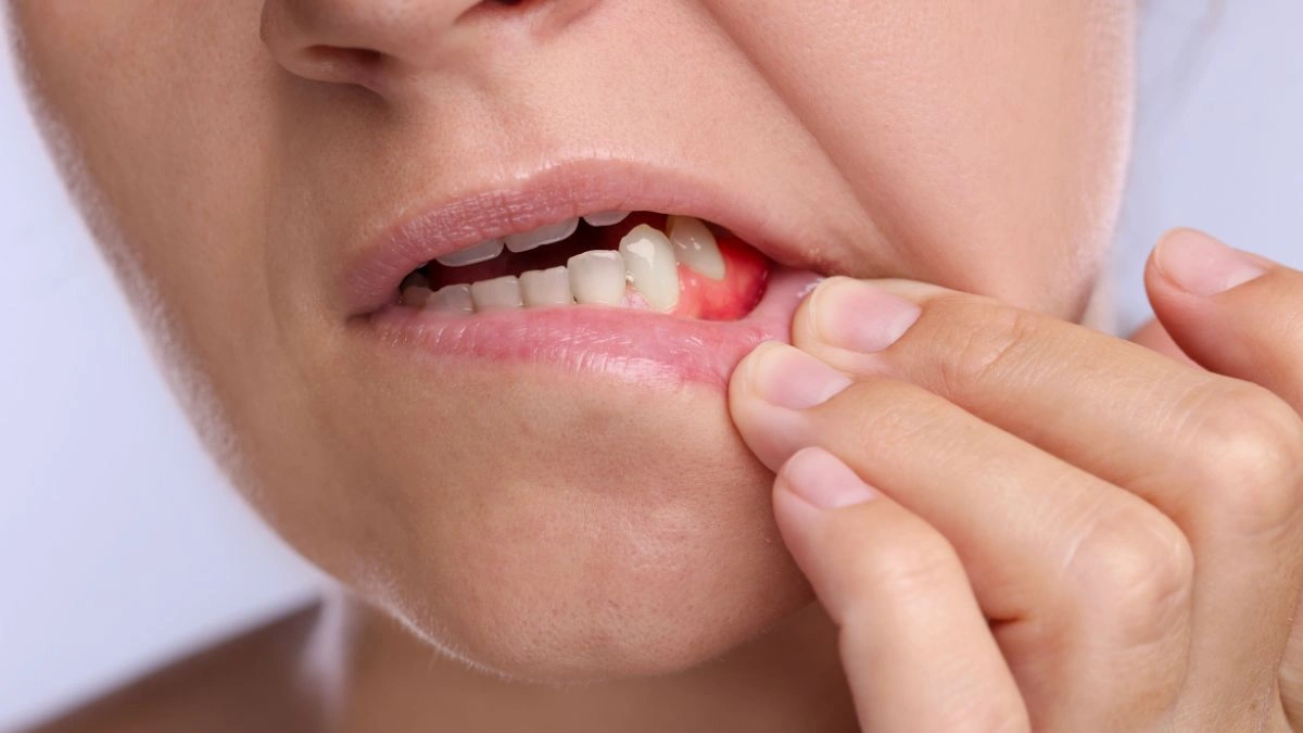 The Epigenetic Memory of Gum Disease Lingers